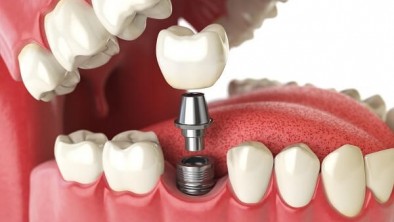 Trồng răng giả là gì? Chi phí 3 phương pháp trồng răng giả?