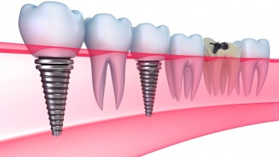 Trồng răng Implant (cấy ghép Implant) có nguy hiểm không và yếu tố nào ảnh hưởng?