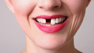Cách trồng răng cửa bằng cấy ghép Implant (trồng răng Implant) không đau