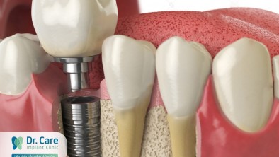 Trồng răng Implant (Cấy ghép Implant) - công nghệ làm răng giả mới nhất hiện nay