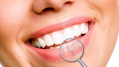 Công dụng của cấy ghép Implant (trồng răng Implant) với răng đã mất