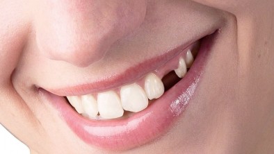 Trồng răng nanh bao nhiêu tiền và phương pháp nào tốt nhất?