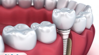 Răng giả bị sâu: Nguyên nhân và cách phục hình răng tốt nhất