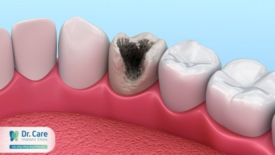 Sâu răng hay gặp ở vị trí nào trên răng?