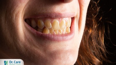 Nguyên nhân gây ra sự lão hóa răng và cách phòng ngừa