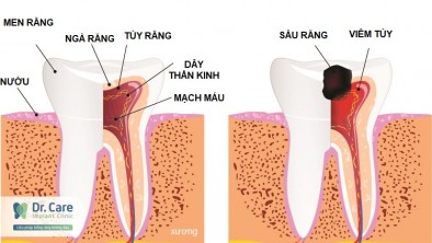 Viêm tủy răng là gì? Những hậu quả khi bị viêm tủy răng?