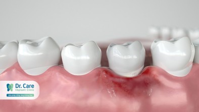 3 biến chứng viêm nướu răng nguy hiểm không ngờ tới