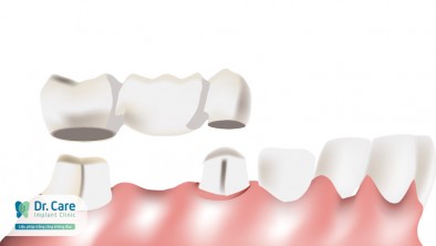 Răng giả bị lung lay làm thế nào để khắc phục?