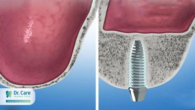Nâng xoang kín, nâng xoang hở - Nên lựa chọn phương pháp nào khi trồng răng Implant?