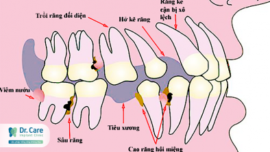 Mất răng có ảnh hưởng gì? 8 nguyên nhân gây mất răng