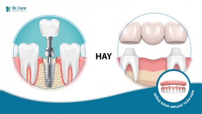 Vì sao nên bỏ cầu răng sứ để trồng răng Implant?