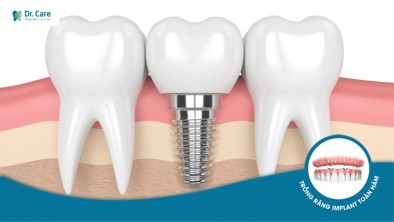 Chỉ 15.5 triệu trồng răng Implant ở Dr. Care, có đáng không?