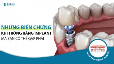 Biến chứng trồng răng Implant sai kỹ thuật