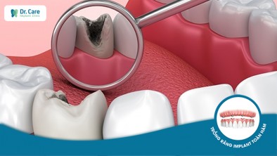 Răng Implant bị vỡ - Nguyên nhân và cách khắc phục