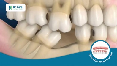 Mất răng vĩnh viễn bẩm sinh, trồng răng Implant có cải thiện được không?