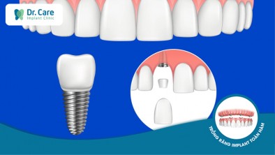 Trồng răng cửa bằng phương pháp Implant có tốt không?
