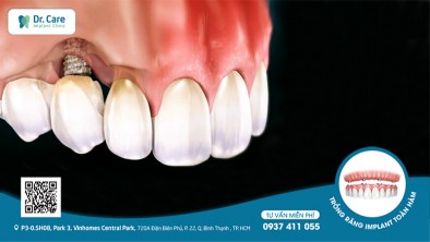 Trồng răng Implant giá rẻ - hậu quả khôn lường