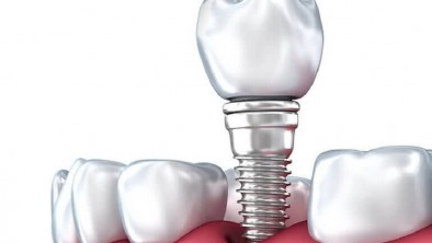 Trồng răng Implant giá rẻ: An toàn hay không?