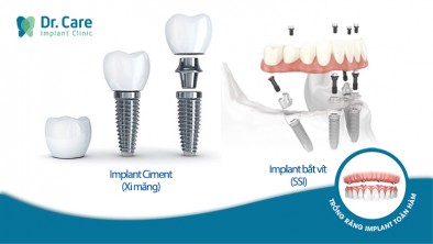 Nên trồng răng Implant bắt vít hay Implant Ciment?