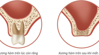 Tiêu xương hàm trầm trọng do mất răng lâu năm, giải pháp nào tốt nhất?