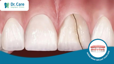 Nguyên nhân cầu răng sứ bị mẻ và cách khắc phục?