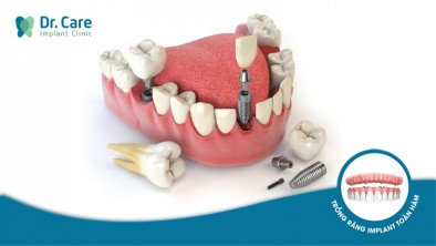 5 yếu tố ảnh hưởng đến tuổi thọ và thẩm mỹ của răng Implant