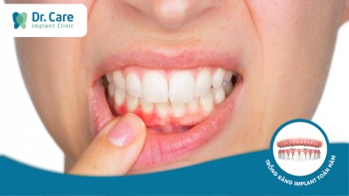 [CHI TIẾT] - 6 dấu hiệu tiêu xương răng thường gặp