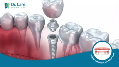 Trồng răng khi bị tiêu xương hàm bằng cần lưu ý gì?