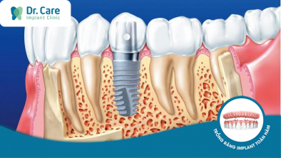 Tiêu xương hàm có ảnh hưởng đến cấy ghép Implant không?