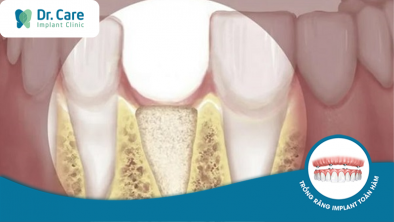 [GIẢI ĐÁP]: Nhổ răng bao lâu thì bị tiêu xương hàm? 