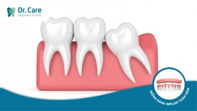 Mọc răng khôn đau trong bao lâu và cách giảm đau hiệu quả
