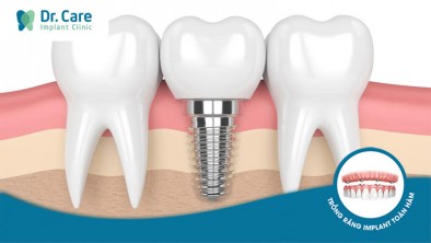 Có nên trồng răng Implant giá rẻ tại Bình Thạnh không?