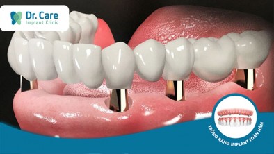 Trồng răng nguyên hàm có tốt không?