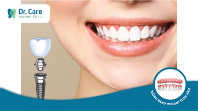 4 Phương pháp trồng răng Implant uy tín tại Dr. Care