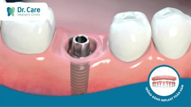 5 rủi ro nghiêm trọng nếu không trồng răng Implant tại nha khoa chuyên sâu