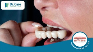 Răng giả tạm thời là gì? Khi nào cần gắn răng giả tạm thời?