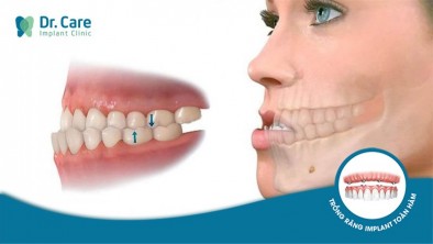 Răng móm là gì? Vì sao mất răng lại bị móm?