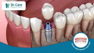 Chảy máu liên tục sau khi trồng răng Implant có nguy hiểm không?