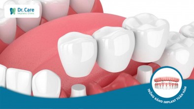 Làm cầu răng sứ bị sưng nướu răng phải làm sao?