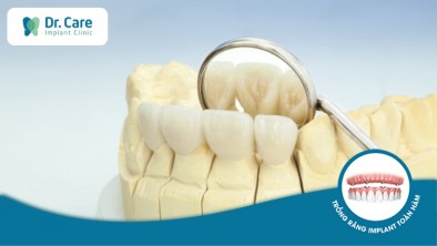 ​​​​​​Răng sứ là gì? 4 loại răng sứ phổ biến