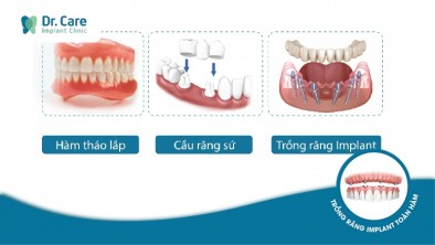 So sánh trồng răng Implant, cầu răng sứ và hàm tháo lắp