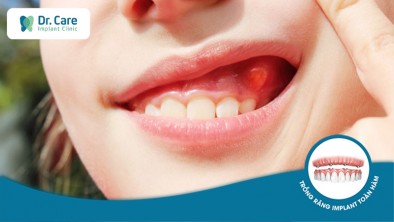 Bị sưng nướu răng có mủ: nguyên nhân và cách điều trị hiệu quả