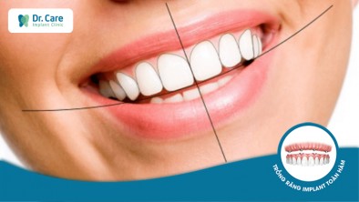 Thế nào là khớp cắn chuẩn? Lợi ích khi trồng răng Implant chuẩn khớp cắn
