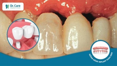 Làm cầu răng sứ bị tụt lợi - Nguyên nhân và cách khắc phục