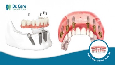 Mất răng toàn hàm nên trồng Implant ở đâu tốt nhất TP. HCM?