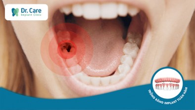 Điều trị sâu răng hàm nặng (trên, dưới) phương pháp nào tốt nhất?