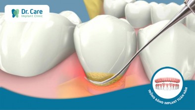 ​​​​​​​Vôi răng là gì? Có nên thường xuyên lấy vôi răng hay không?