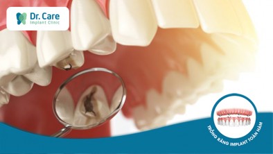 ​​​​​​​Răng cấm là răng nào? Có cần điều trị răng cấm bị hư không?
