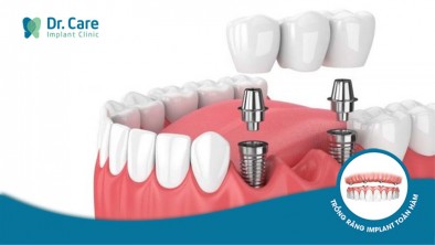 Mất 3 răng liền kề: Phương pháp nào phục hồi hiệu quả?