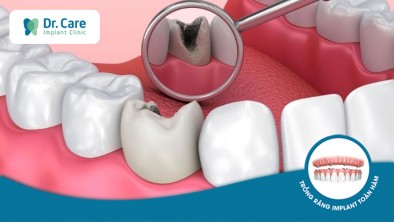 Tác hại của sâu răng là gì? Tại sao phải điều trị sâu răng?